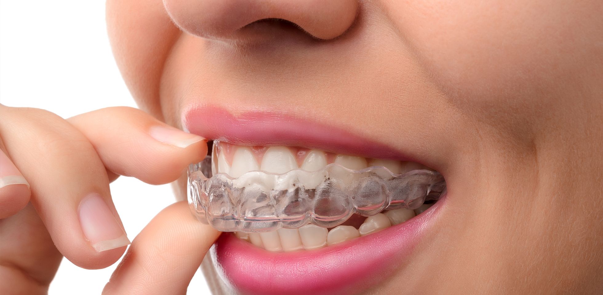 Les gouttières dentaires plébiscitées par les influenceurs ne le sont pas par les professionnels